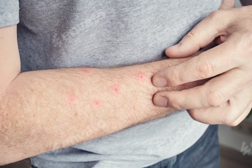 Preview: Caucasian male examining red bumps on forearm skin rash