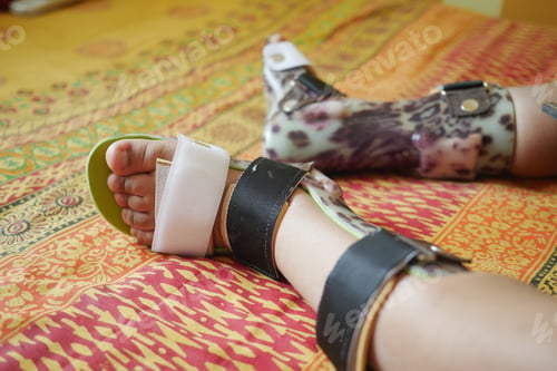 Preview: Child cerebral palsy disability, legs orthosis.