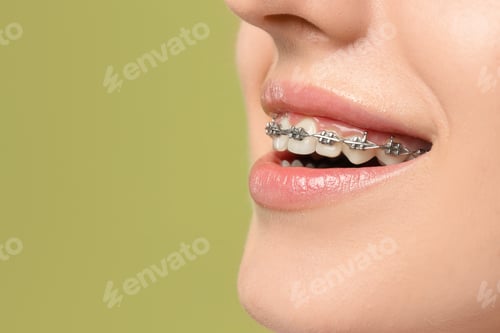 Preview: Smiling woman with dental braces on light green background, closeup. Space for text