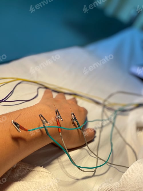 Preview: Electro-Acupuncture.Traditional Chinese acupuncture and Electro acupuncture on body of patient