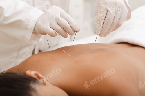 Preview: Acupuncturist punctures needle at special points on the back and is very accurate