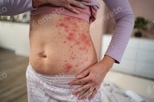 Preview: Woman showing red skin rash from allergy or illness