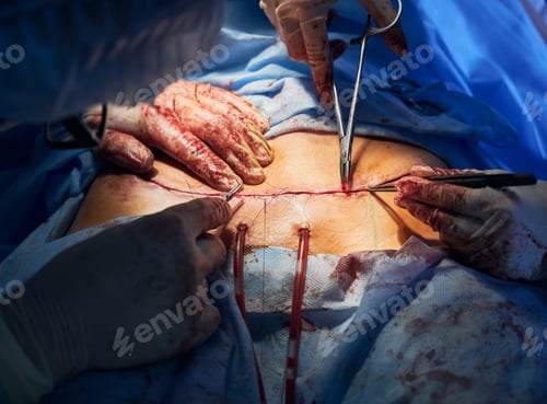 Preview: Surgeons Performing a Surgical Procedure in Hospital