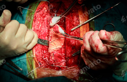 Preview: Closing close-up chest after heart surgery in a hospital ward