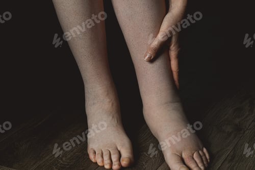Preview: Female legs affected by edema or lymphedema condition