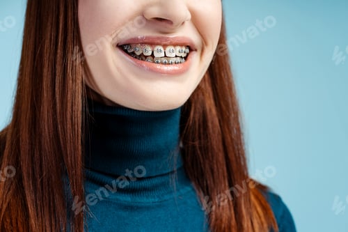 Preview: Woman showcasing her braces, featured in a closeup shot, isolated on a blue background