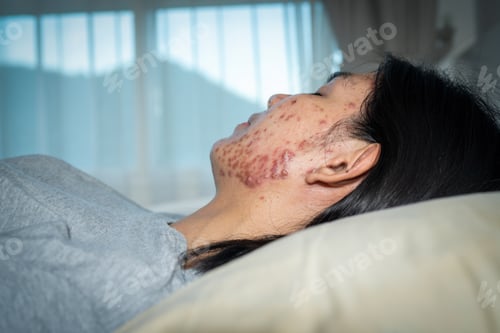 Preview: Pillows Cause Acne, Acne on Your face might be suffering when you rest your head upon