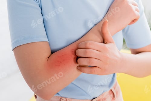 Preview: Cropped view of woman with allergy scratching arm