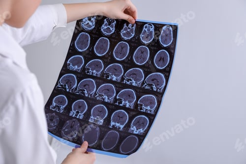 Preview: Doctor examining MRI images of patient with multiple sclerosis in clinic, closeup