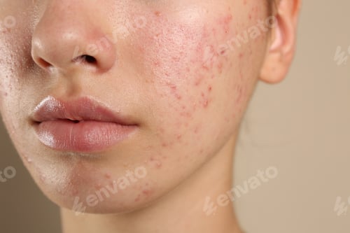 Preview: Teenage girl with acne problem on beige background, closeup