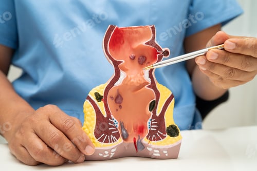 Preview: Asian doctor with rectum and hemorrhoid human anatomy model