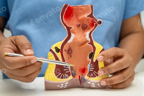 Preview: Asian doctor with rectum and hemorrhoid human anatomy model at hospital