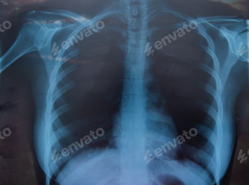 Preview: Woman xray for chest and lungs examination