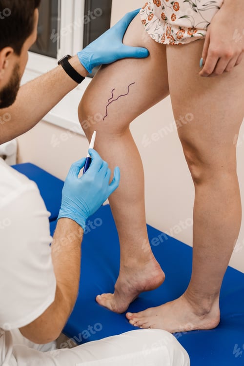 Preview: Vascular surgeon marks veins for varicose surgery pre-operatively in medical clinic