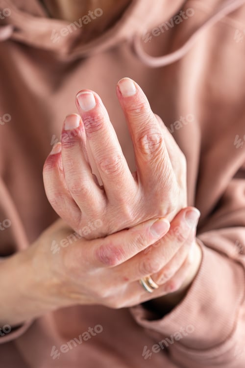 Preview: Woman hands with atopic dermatitis, eczema, allergy reaction on skin