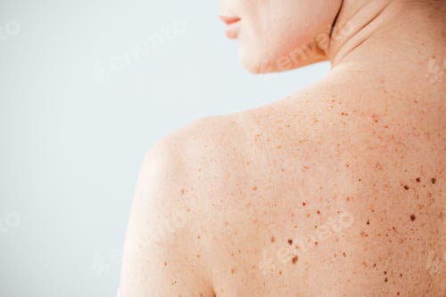 Preview: cropped view of diseased and naked woman with moles on skin on white