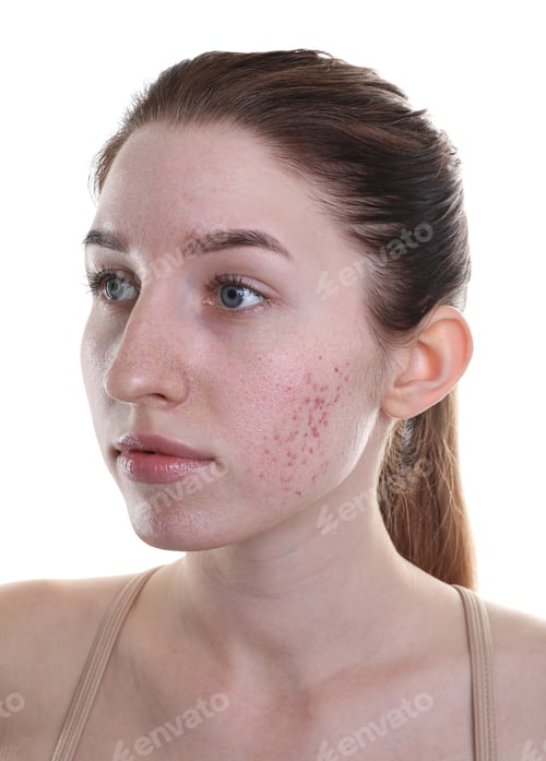 Preview: Young woman with acne problem on white background