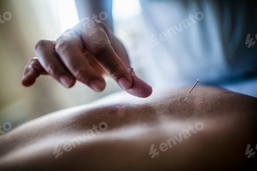 Preview: Close up of hand holding fine needle, performing acupuncture on a patient's back