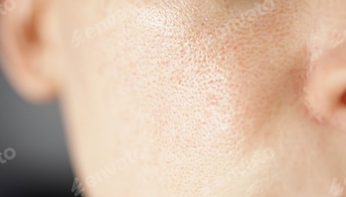Preview: Skin texture, unhealthy with with enlarged pores and rosacea, red rashes. Allergic and redness.
