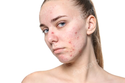 Preview: Young woman with acne problem on white background