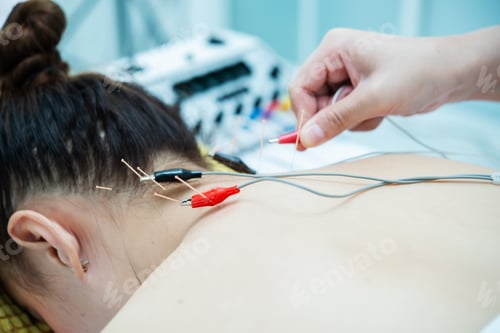 Preview: Close-up of electroacupuncture therapy on a patient’s upper back and neck.
