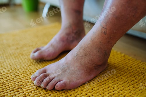 Preview: A close-up shot of man's feet with diabetic foot complications.