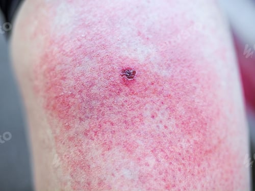 Preview: Insect bite on skin large red swollen area
