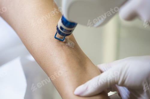 Vista previa: Laser hair or scar removal from the skin. CO2 technique.