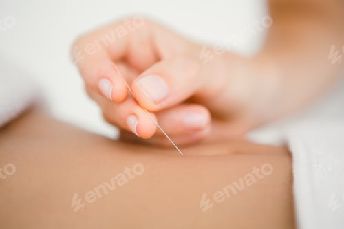 Preview: Close up view of woman holding a needle in an acupuncture therapy