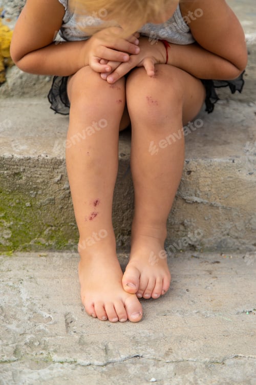 Preview: A child has a scratch on his leg. Selective focus.