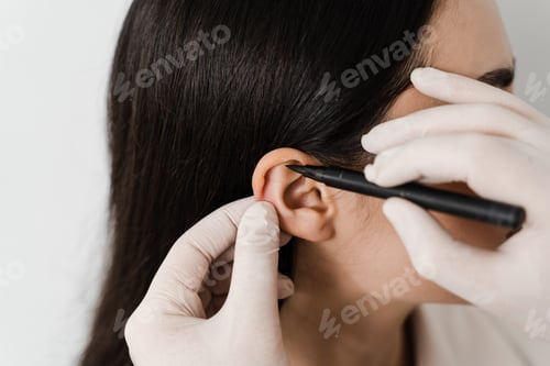 Preview: Otoplasty pre-op close-up of surgeon marking girl's ear for cosmetic pinna surgery