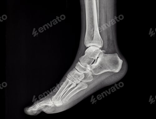 Preview: an x-ray of the sole of the human foot