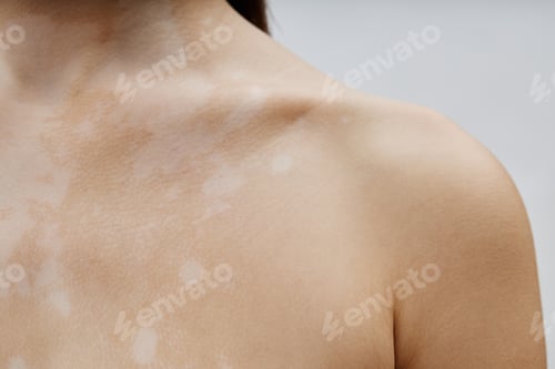 Preview: Skin with White Patches on Collarbone of Young Girl with Vitiligo in Studio