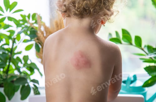 Preview: Mosquito bites on a child back. Selective focus.