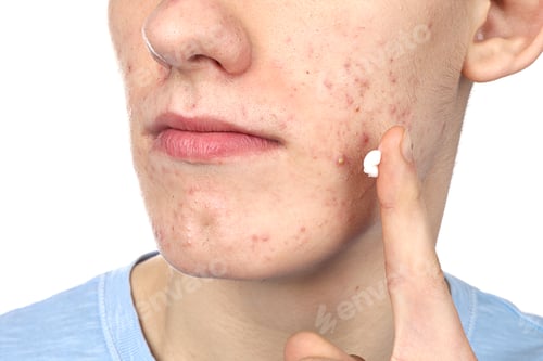 Preview: Young man with acne problem applying cosmetic product onto his skin on white background, closeup