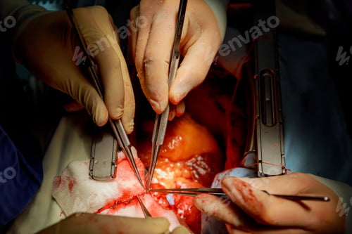 Preview: Heart surgery. Open heart surgery. Coronary artery bypass surger in operating room