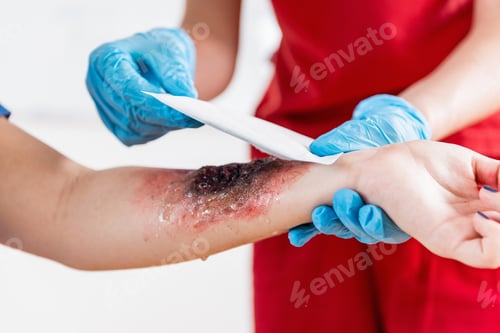 Preview: First Aid Training - Burn injury