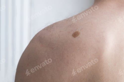 Preview: Nevus on back shoulder of man, space for text