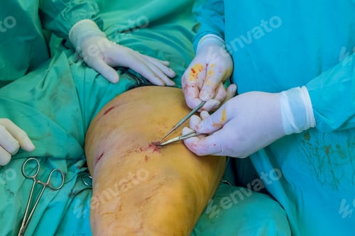 Preview: In order to address injuries, doctors specializing in orthopedics perform leg surgeries on patient.
