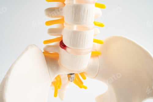 Preview: Lumbar spine displaced herniated disc fragment, spinal nerve and bone.