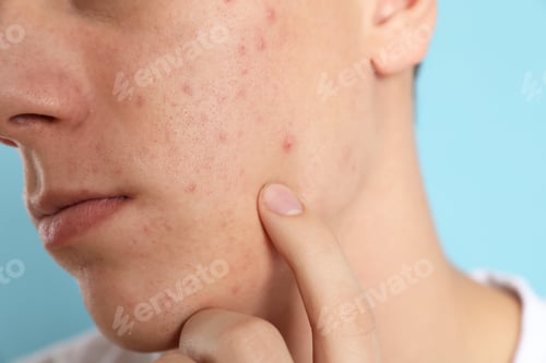 Preview: Teen guy with acne problem on light blue background, closeup