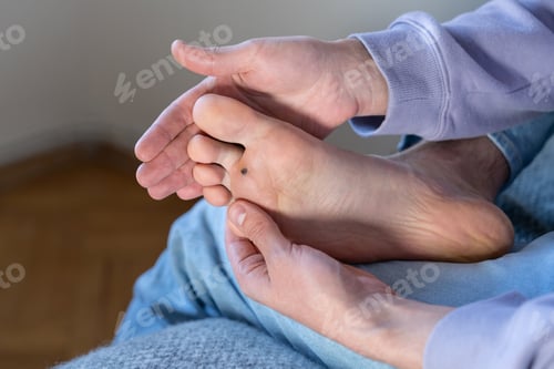 Preview: Man checks wart at home after cauterizing it with celandine on foot. Verrucas papilloma callus virus