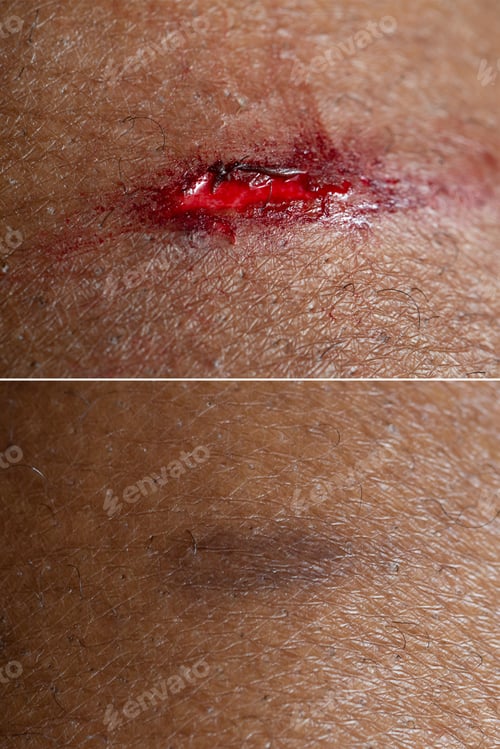 Preview: Superficial wound before and after a connective tissue treatment