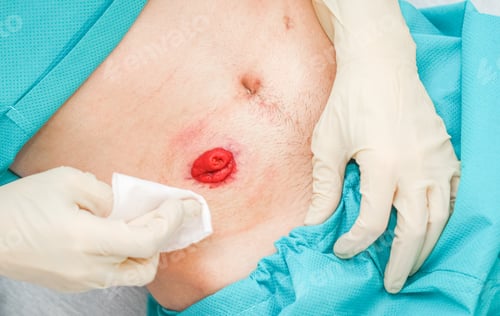 Preview: A young patient in pajamas and sterile gloves cleans the intestines on his stomach with a napkin.