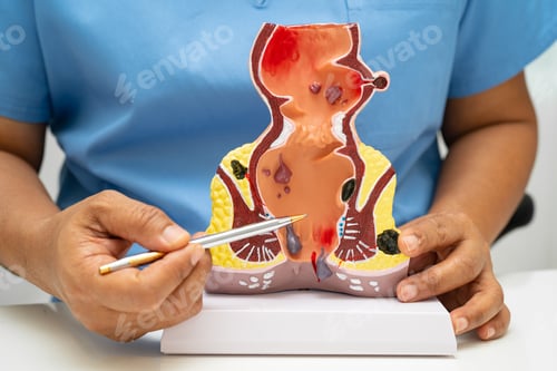 Preview: Asian doctor with rectum and hemorrhoid human anatomy model at hospital, inflamed vascular