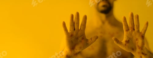 Preview: Male hands affected by blistering rash because of monkeypox or other viral infection on yellow