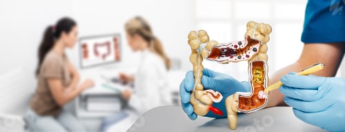 Preview: Treatment cancer colon. Doctor pointing pen tumor intestines using an anatomical model.