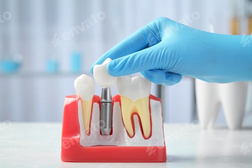 Preview: Dentist putting crown onto abutment of dental implant between teeth at table indoors, closeup