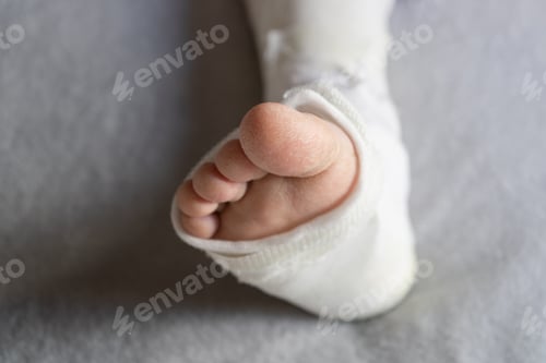 Preview: Fracture of the ankle bones in a female patient with a cast and crutches.