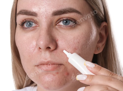 Preview: Woman applying cream onto face on white background. Acne treatment